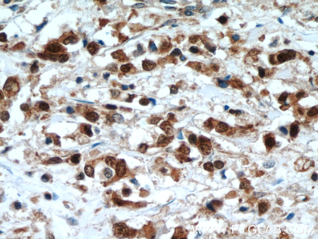 Immunohistochemistry (IHC) staining of human breast cancer tissue using LASP1 Polyclonal antibody (10515-1-AP)