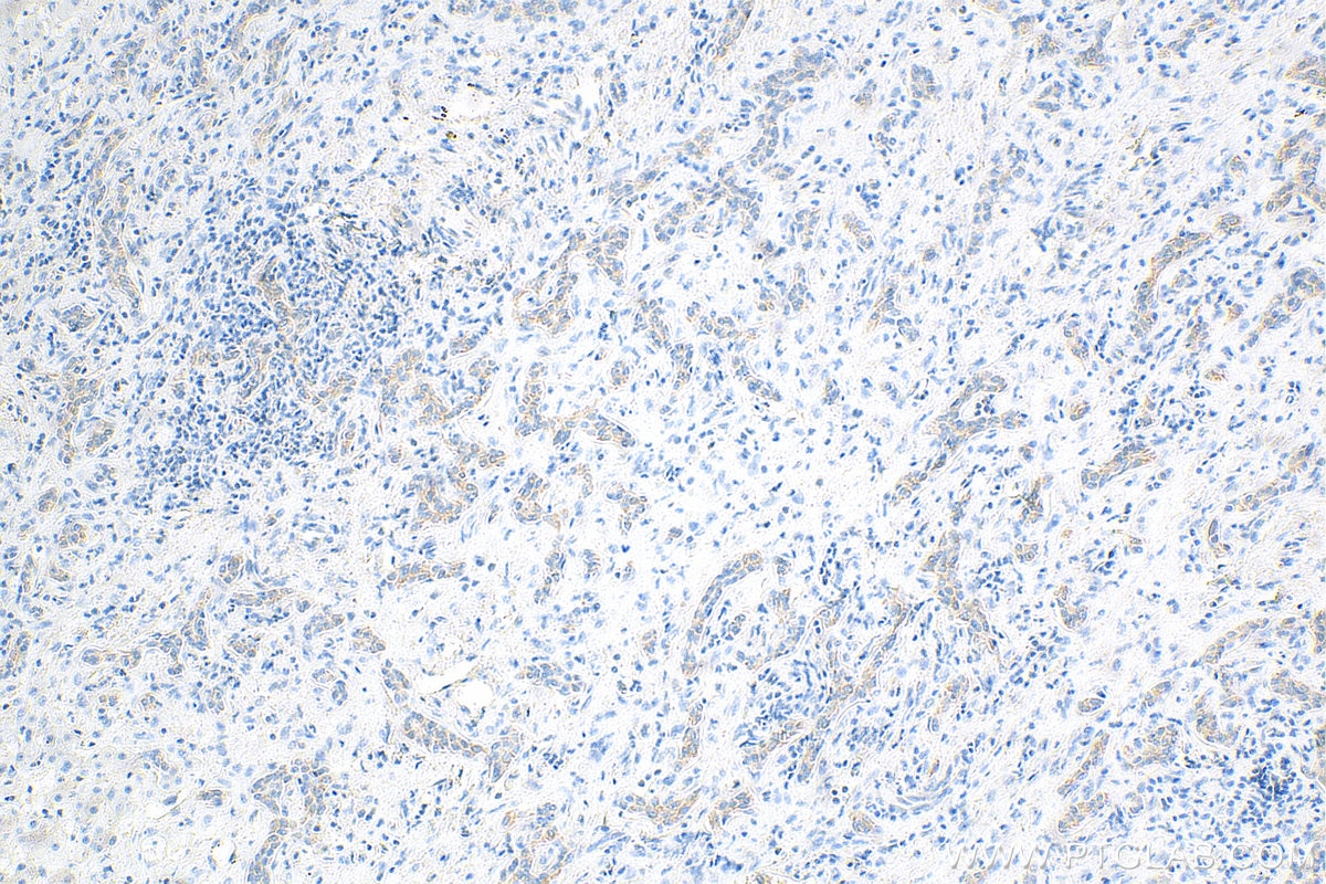 Immunohistochemistry (IHC) staining of human liver cancer tissue using LASP1 Monoclonal antibody (68080-1-Ig)