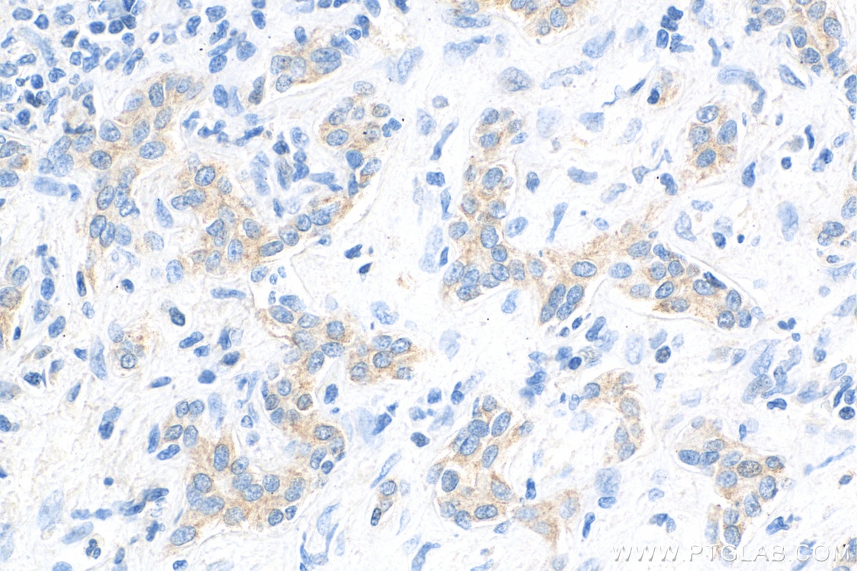 Immunohistochemistry (IHC) staining of human liver cancer tissue using LASP1 Monoclonal antibody (68080-1-Ig)