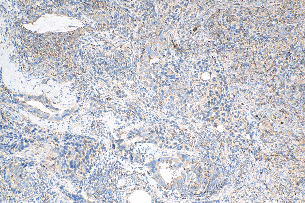 IHC staining of human breast cancer using 68080-1-Ig