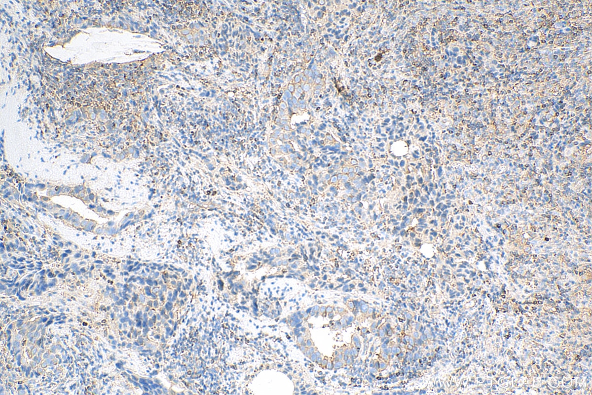 Immunohistochemistry (IHC) staining of human breast cancer tissue using LASP1 Monoclonal antibody (68080-1-Ig)