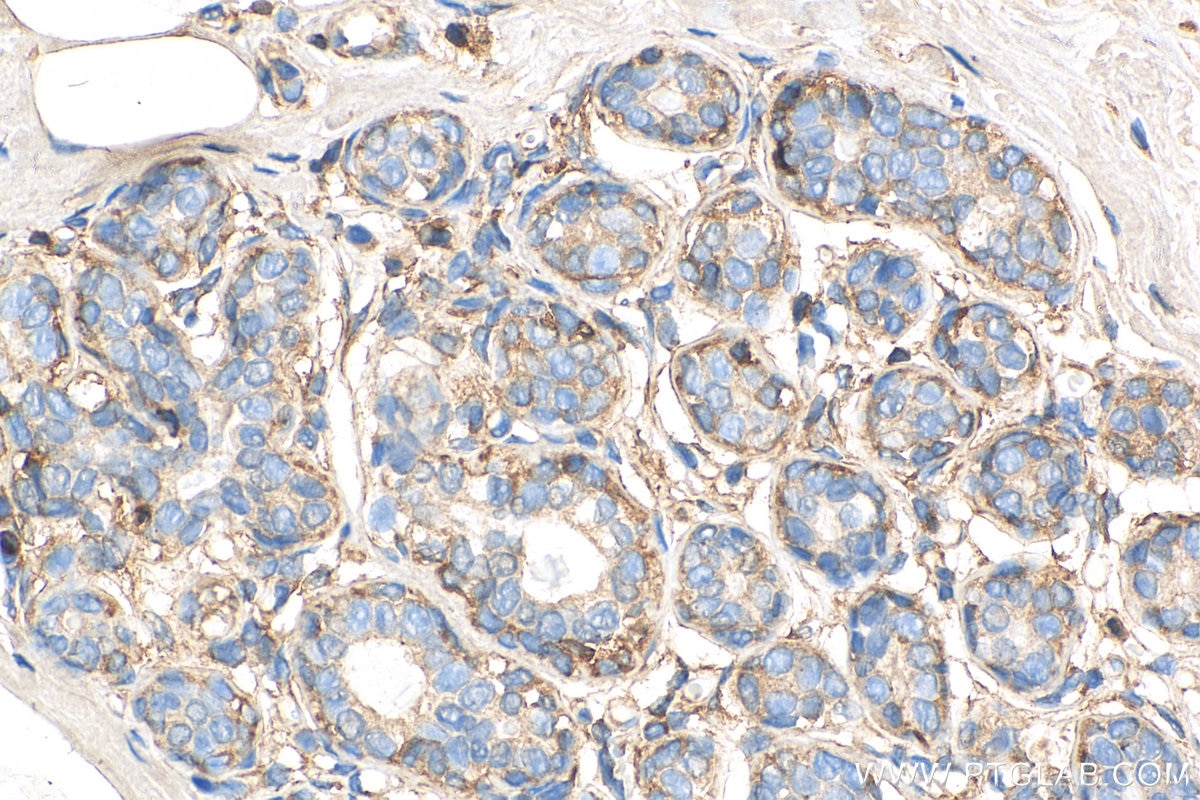 Immunohistochemistry (IHC) staining of human breast cancer tissue using LASP1 Monoclonal antibody (68080-1-Ig)