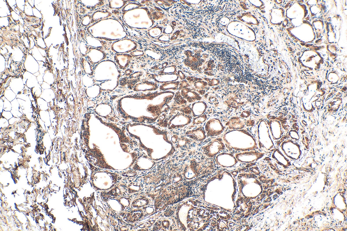 IHC staining of human thyroid cancer using 20344-1-AP Immunohistochemistry (IHC) staining of human thyroid cancer tissue using LASS2 Polyclonal antibody (20344-1-AP)