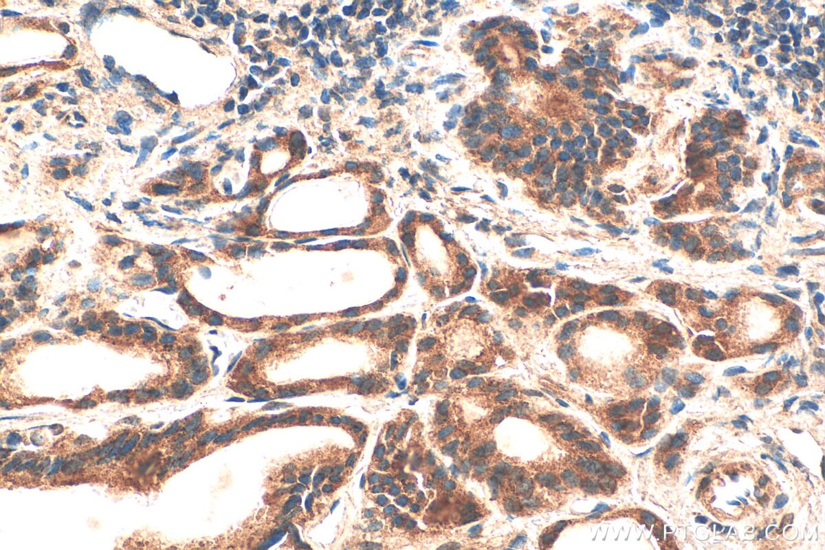 Immunohistochemistry (IHC) staining of human thyroid cancer tissue using LASS2 Polyclonal antibody (20344-1-AP)