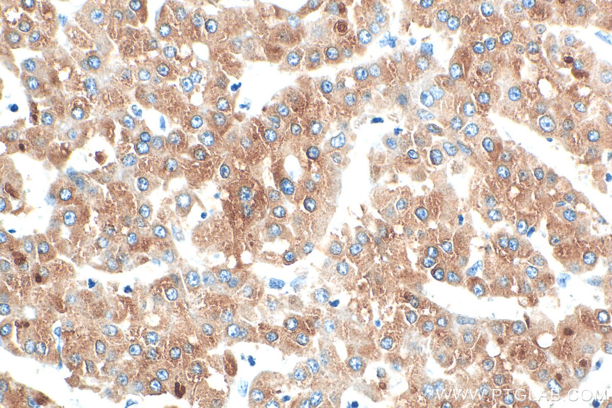 Immunohistochemistry (IHC) staining of human liver cancer tissue using LASS2 Polyclonal antibody (30183-1-AP)