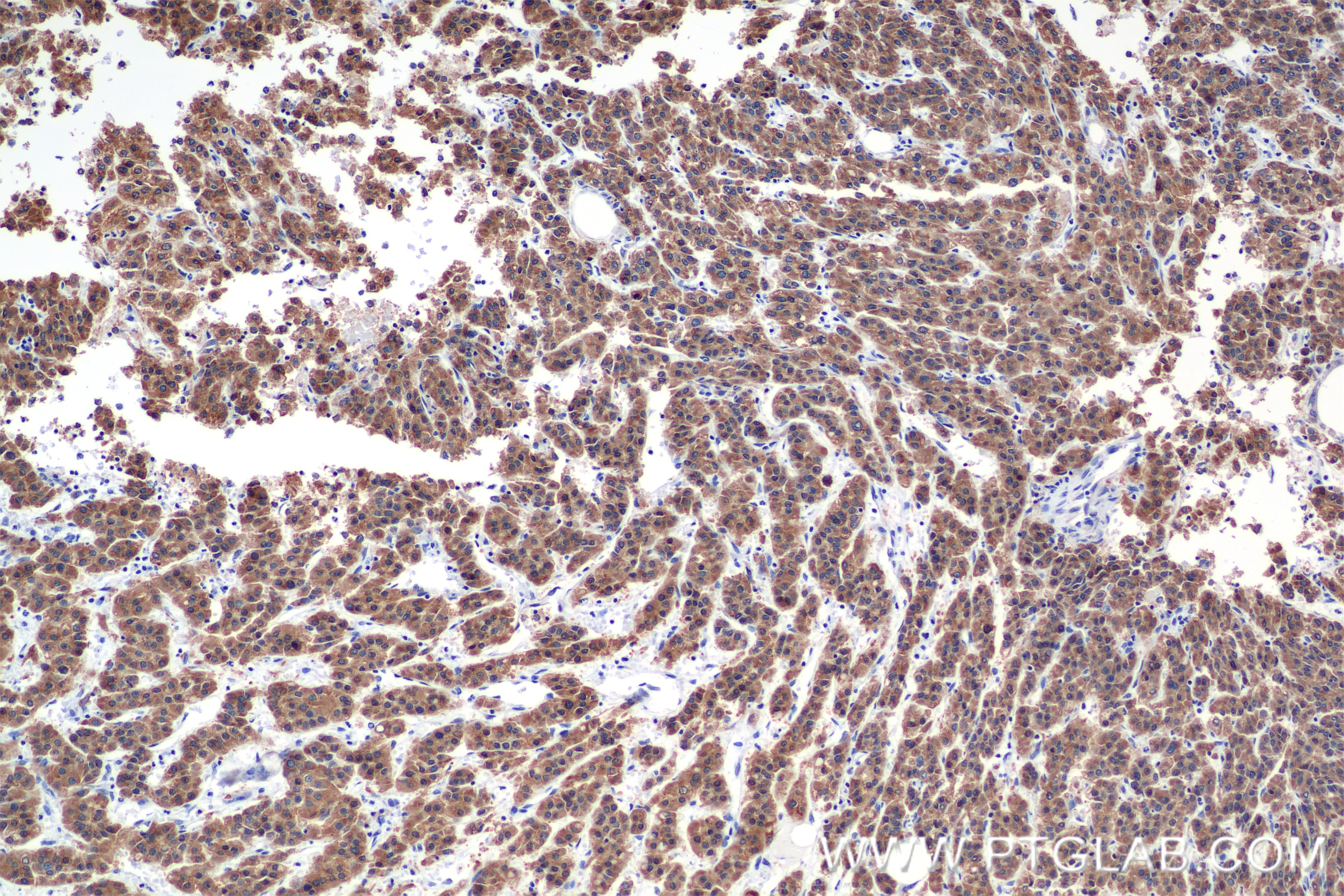 Immunohistochemistry (IHC) staining of Human Hepatocellular cancer using LASS2 Recombinant antibody (84514-4-RR)