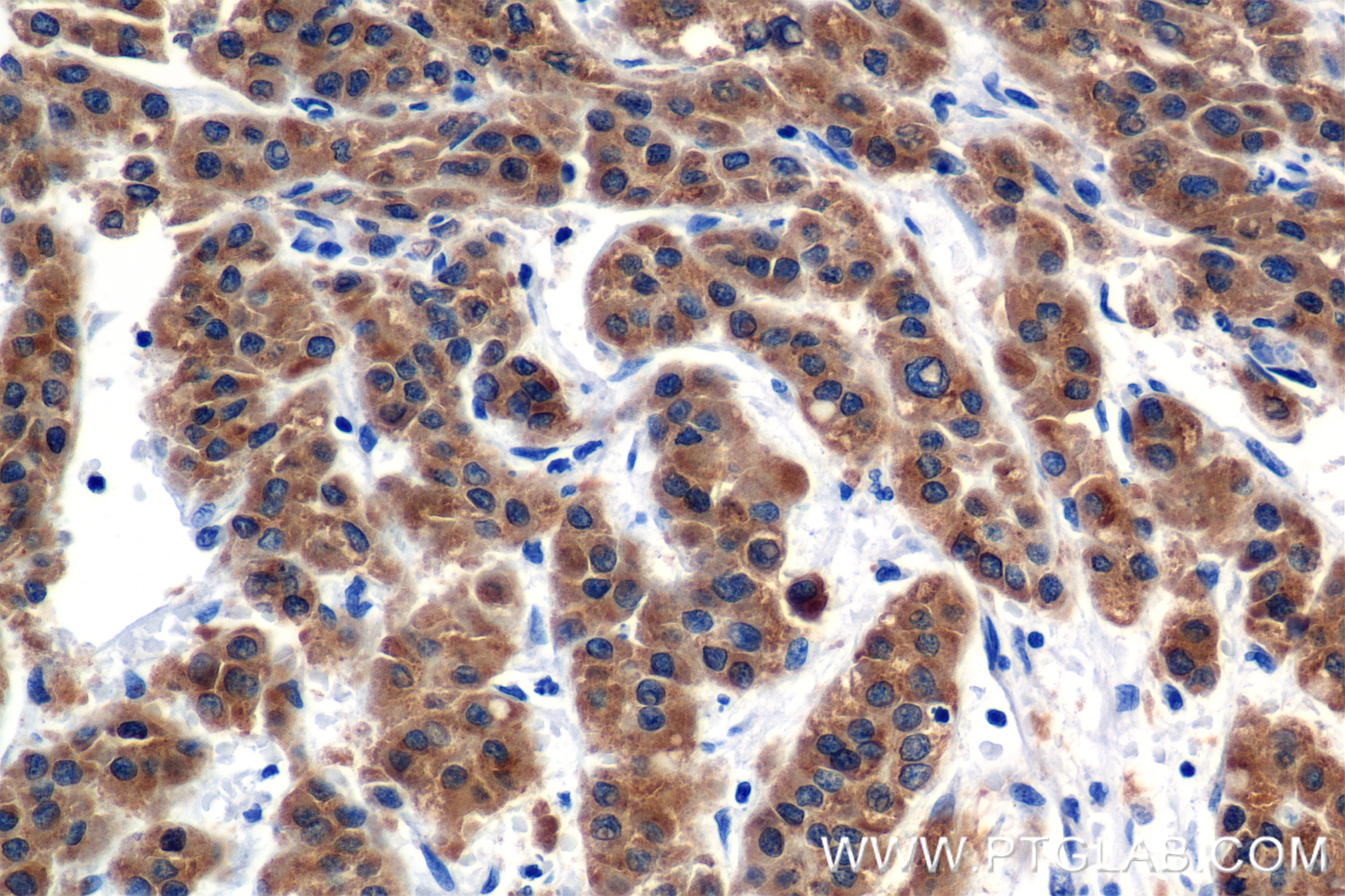 Immunohistochemistry (IHC) staining of Human Hepatocellular cancer using LASS2 Recombinant antibody (84514-4-RR)