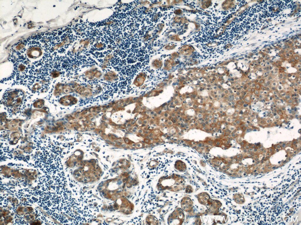 Immunohistochemistry (IHC) staining of human breast cancer tissue using LATH Polyclonal antibody (19763-1-AP)