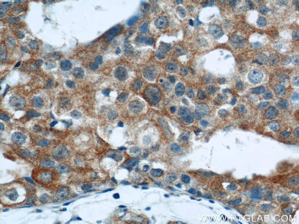 IHC staining of human breast cancer using 19763-1-AP