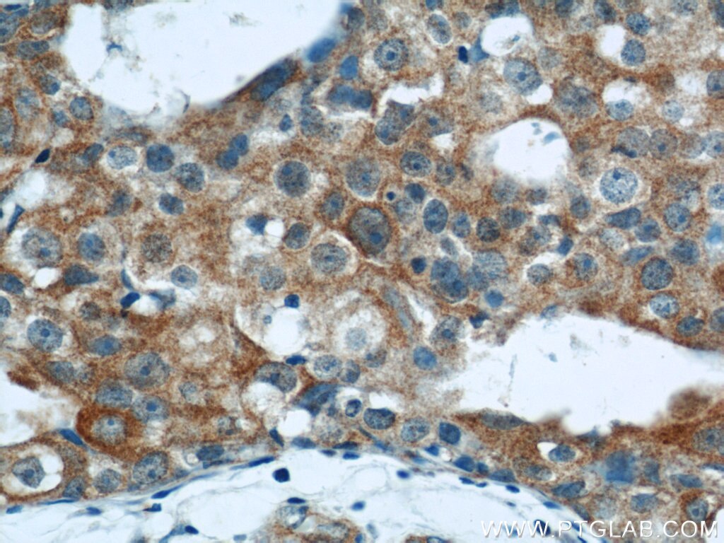 Immunohistochemistry (IHC) staining of human breast cancer tissue using LATH Polyclonal antibody (19763-1-AP)