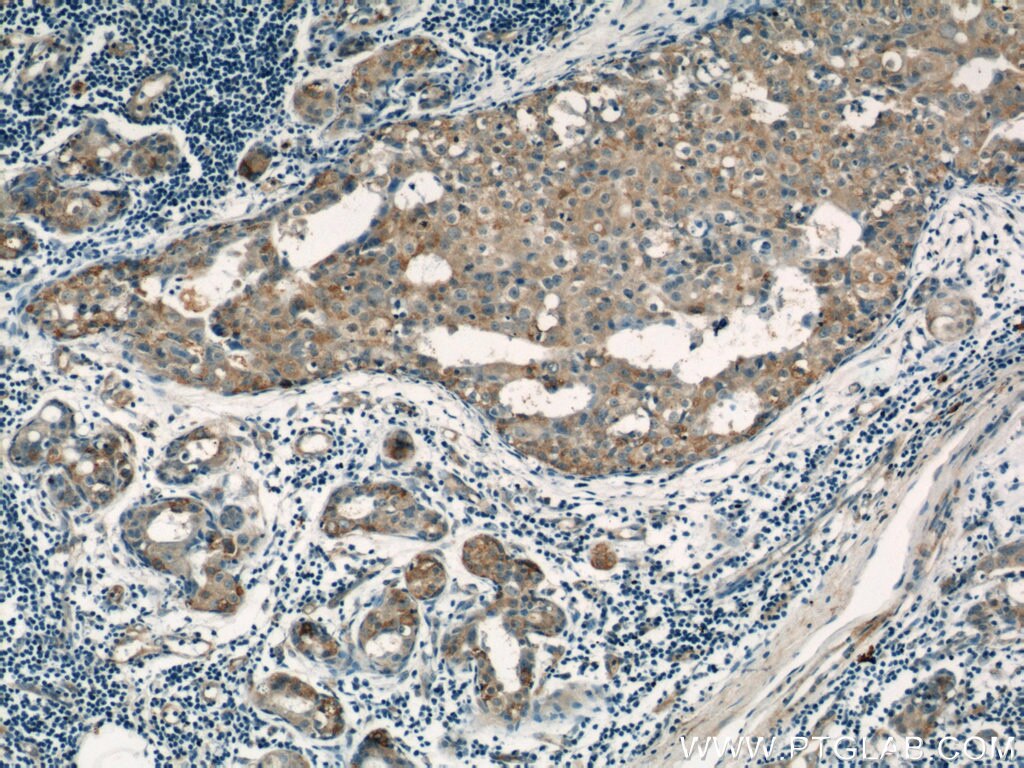 Immunohistochemistry (IHC) staining of human breast cancer tissue using LATH Polyclonal antibody (19763-1-AP)