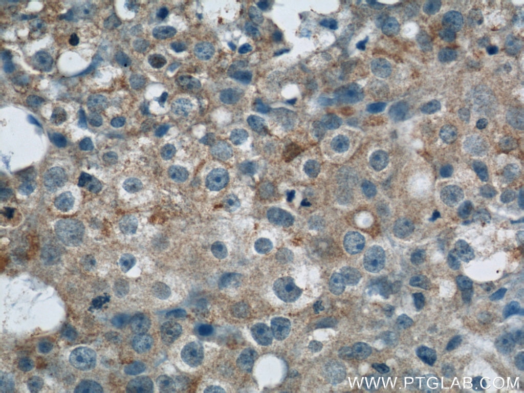Immunohistochemistry (IHC) staining of human breast cancer tissue using LATH Polyclonal antibody (19763-1-AP)