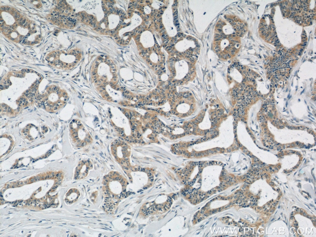 IHC staining of human breast cancer using 19763-1-AP