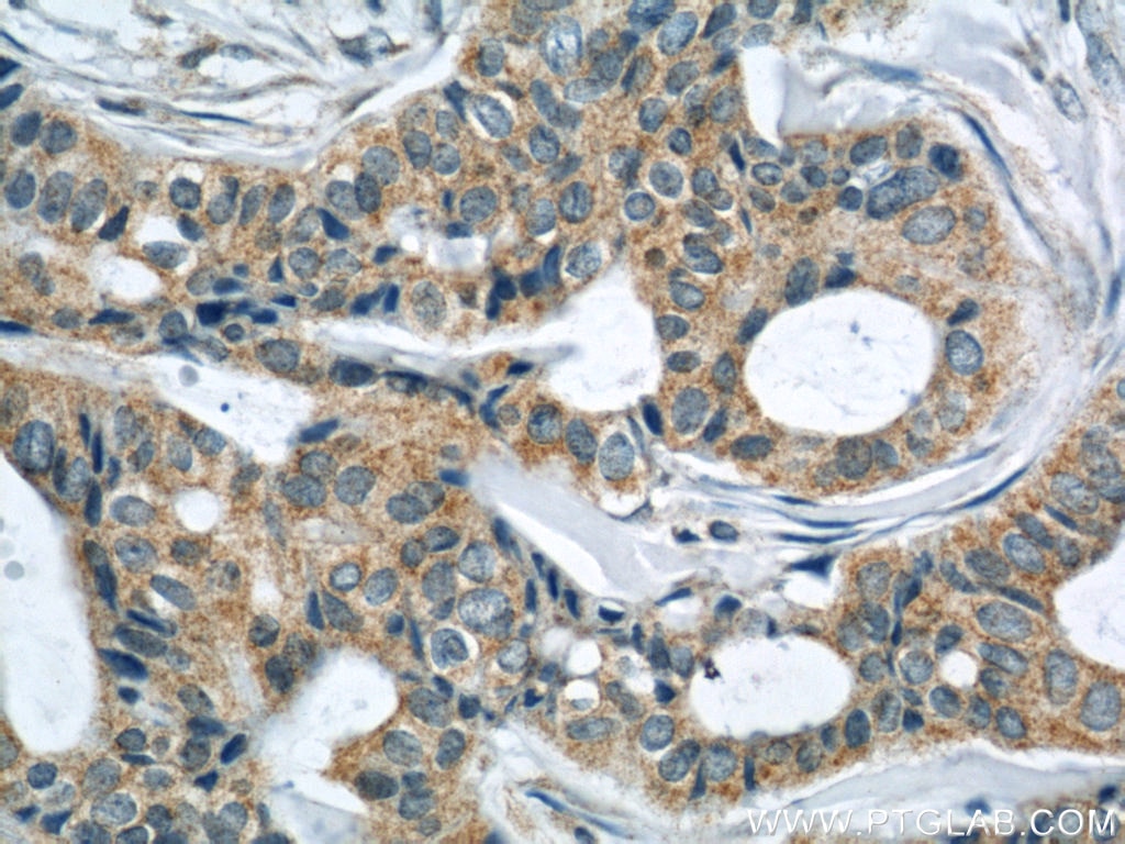 Immunohistochemistry (IHC) staining of human breast cancer tissue using LATH Polyclonal antibody (19763-1-AP)