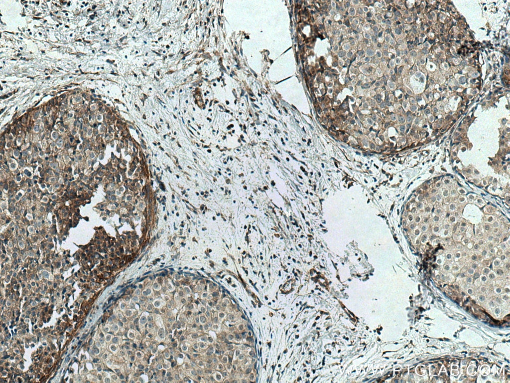 Immunohistochemistry (IHC) staining of human breast cancer tissue using LATS1 Polyclonal antibody (17049-1-AP)
