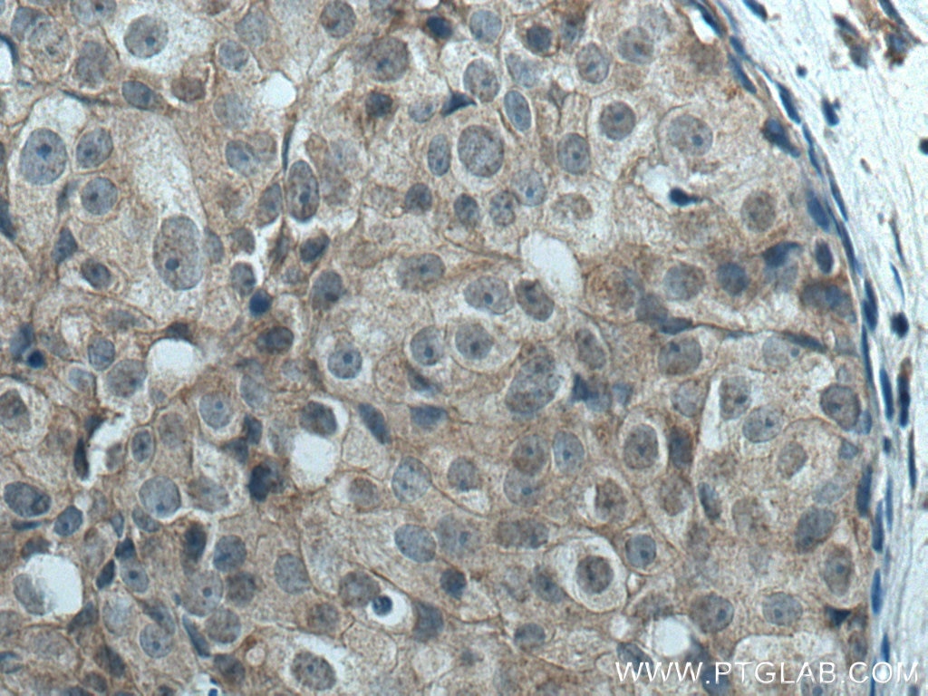 Immunohistochemistry (IHC) staining of human breast cancer tissue using LATS1 Polyclonal antibody (17049-1-AP)