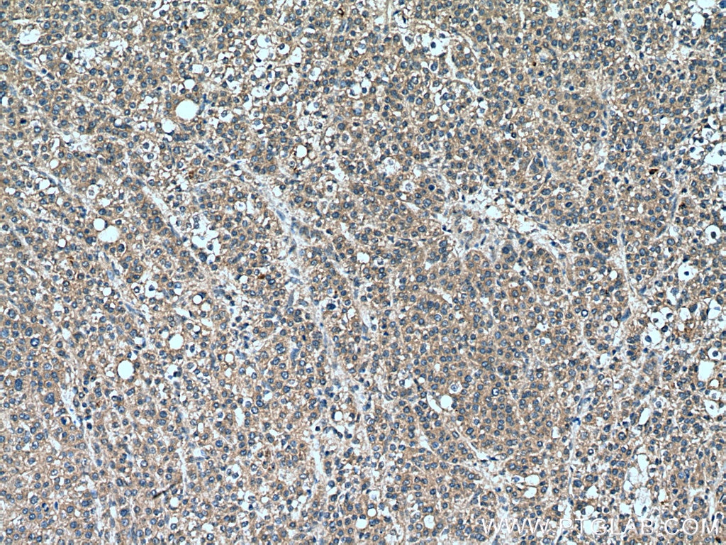 Immunohistochemistry (IHC) staining of human liver cancer tissue using LATS2-Specific Polyclonal antibody (20276-1-AP)