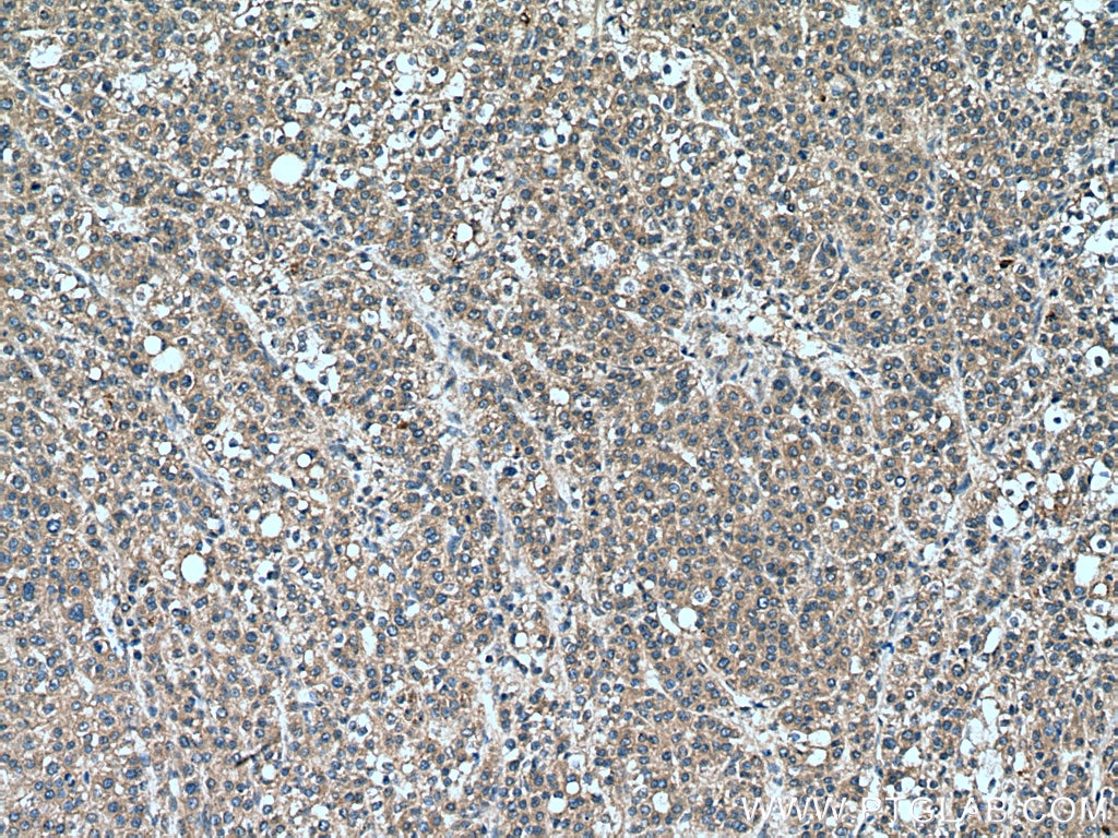 IHC staining of human liver cancer using 20276-1-AP