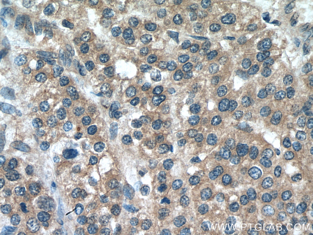 IHC staining of human liver cancer using 20276-1-AP