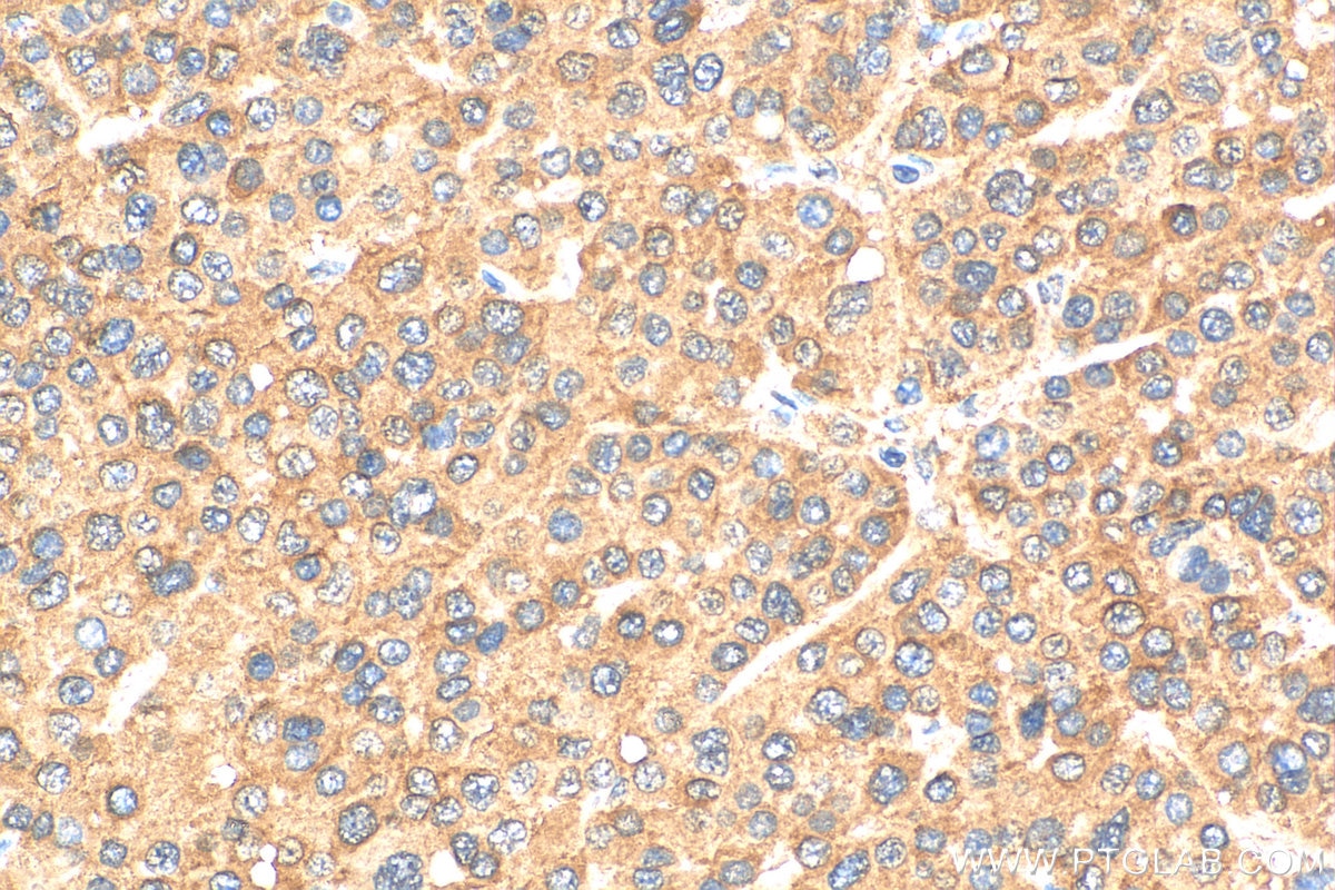 Immunohistochemistry (IHC) staining of human liver cancer tissue using LATS2-Specific Polyclonal antibody (20276-1-AP)