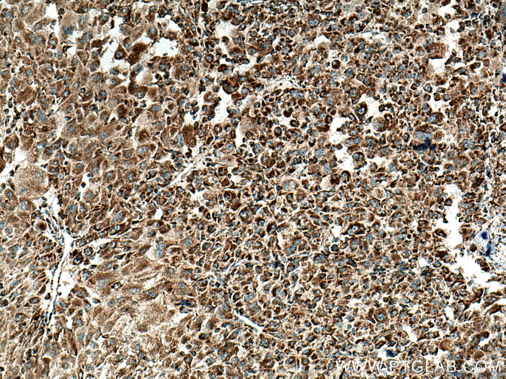 Immunohistochemistry (IHC) staining of human liver cancer tissue using LAYN Polyclonal antibody (20535-1-AP)