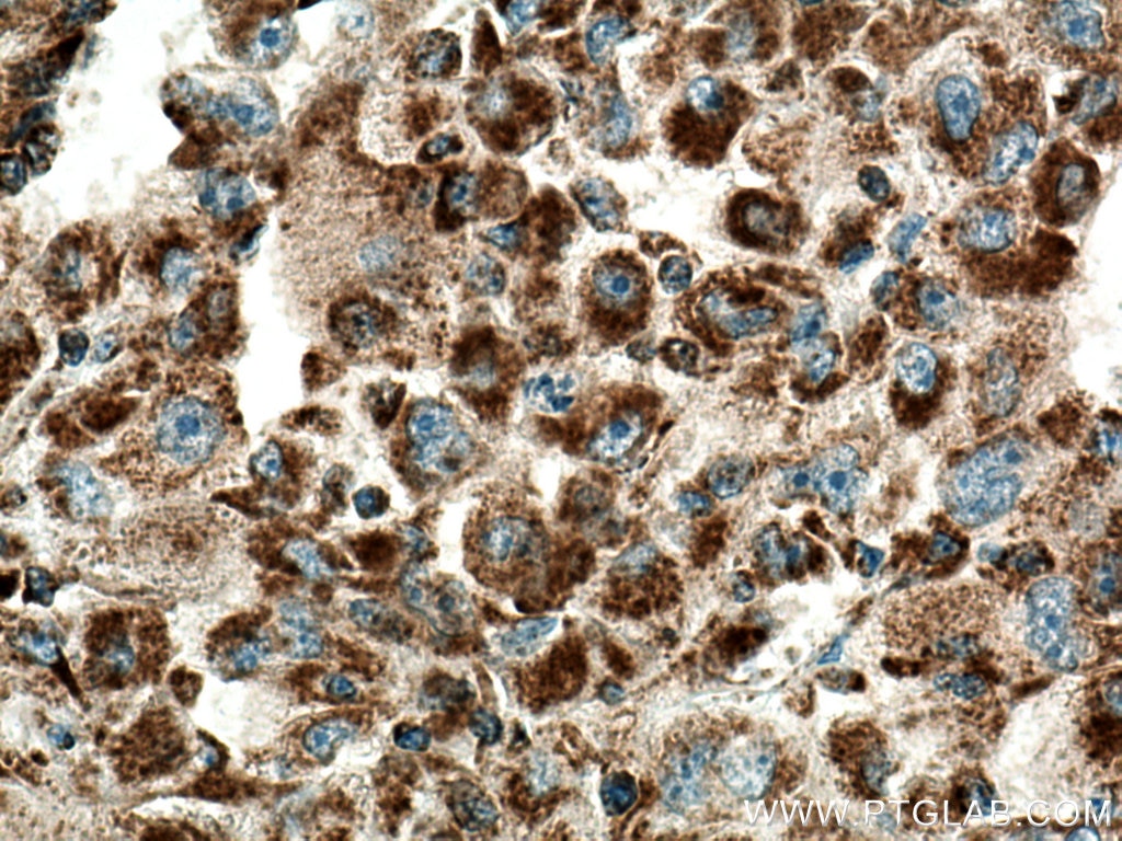Immunohistochemistry (IHC) staining of human liver cancer tissue using LAYN Polyclonal antibody (20535-1-AP)