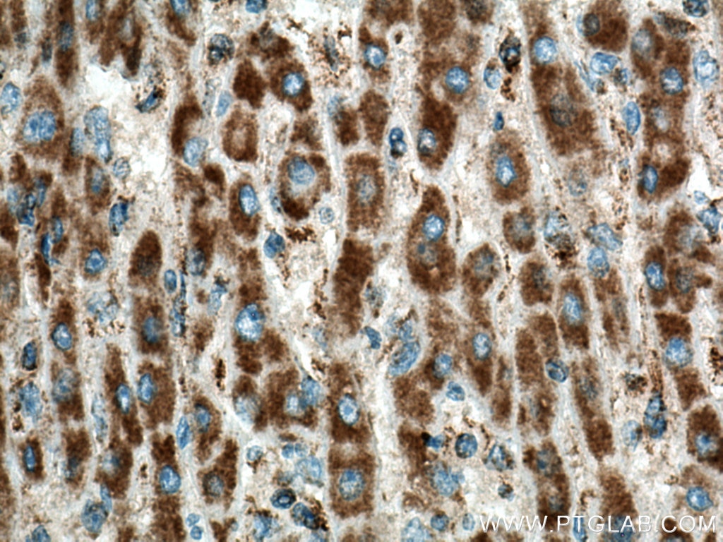 Immunohistochemistry (IHC) staining of human liver cancer tissue using LAYN Polyclonal antibody (20535-1-AP)