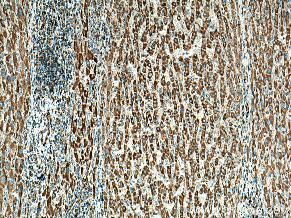 IHC staining of human liver cancer using 20535-1-AP