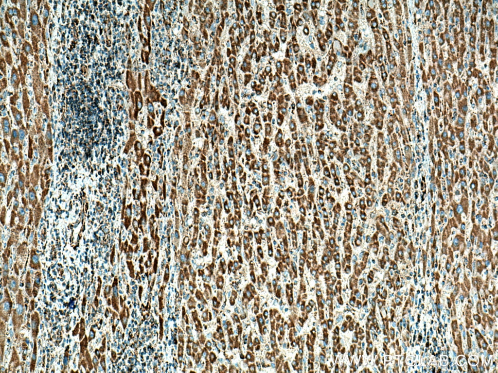 Immunohistochemistry (IHC) staining of human liver cancer tissue using LAYN Polyclonal antibody (20535-1-AP)