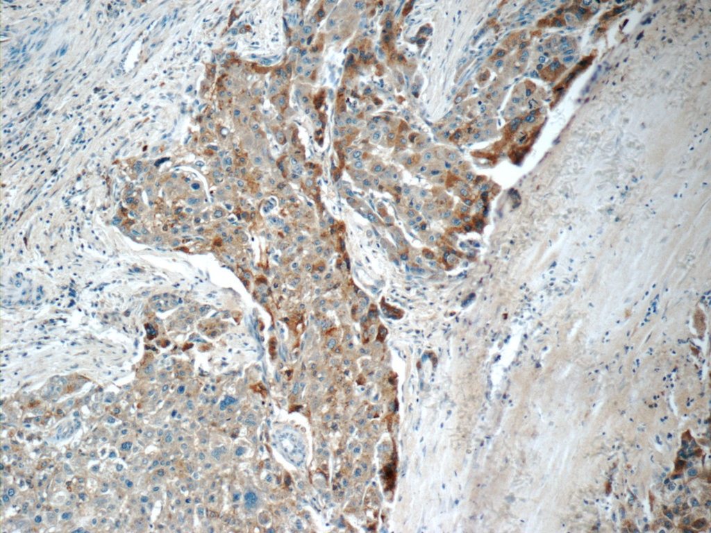 IHC staining of human liver cancer using 66181-1-Ig