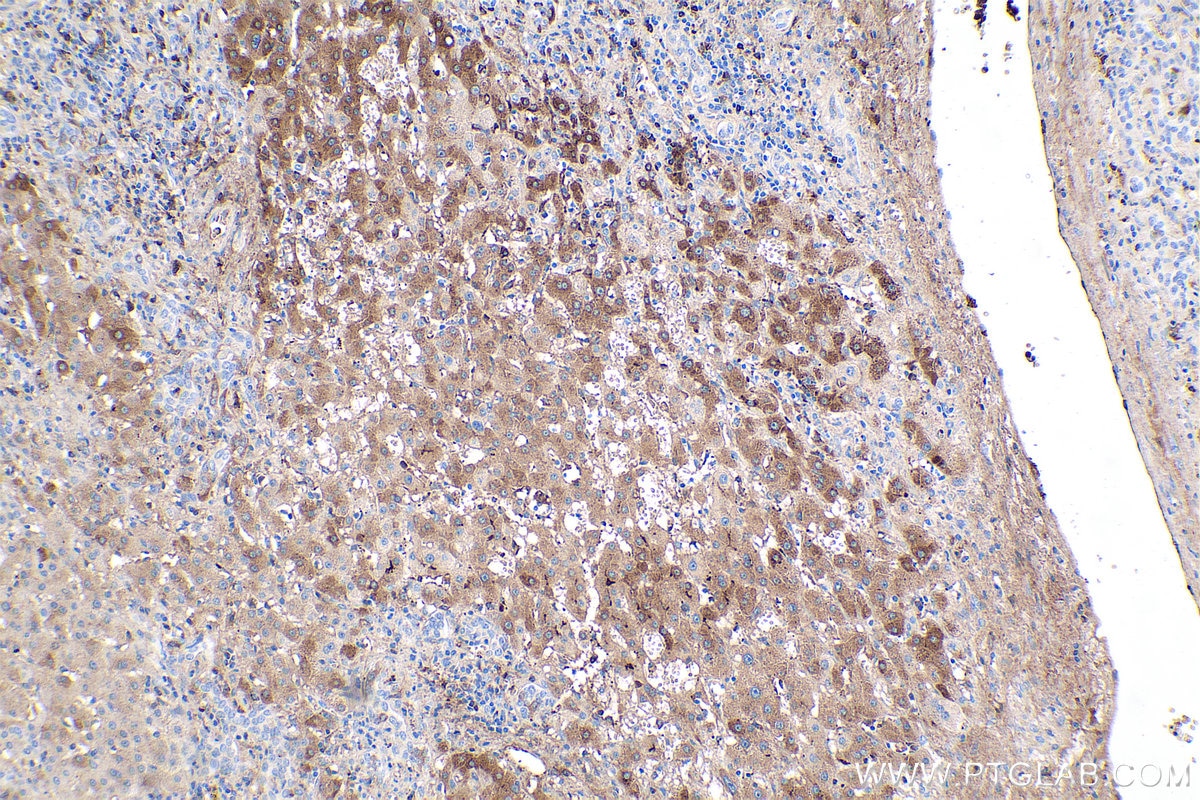 Immunohistochemistry (IHC) staining of human liver cancer tissue using LBP Monoclonal antibody (66181-1-Ig)