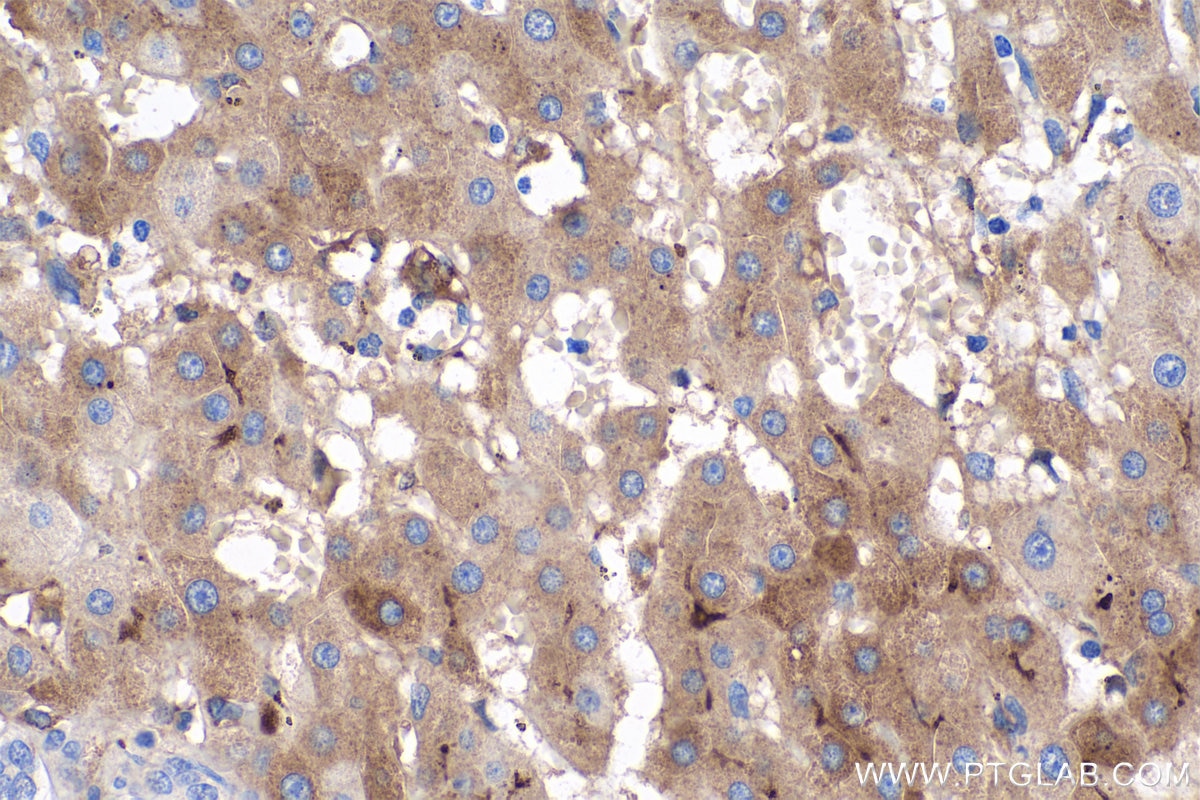 Immunohistochemistry (IHC) staining of human liver cancer tissue using LBP Monoclonal antibody (66181-1-Ig)