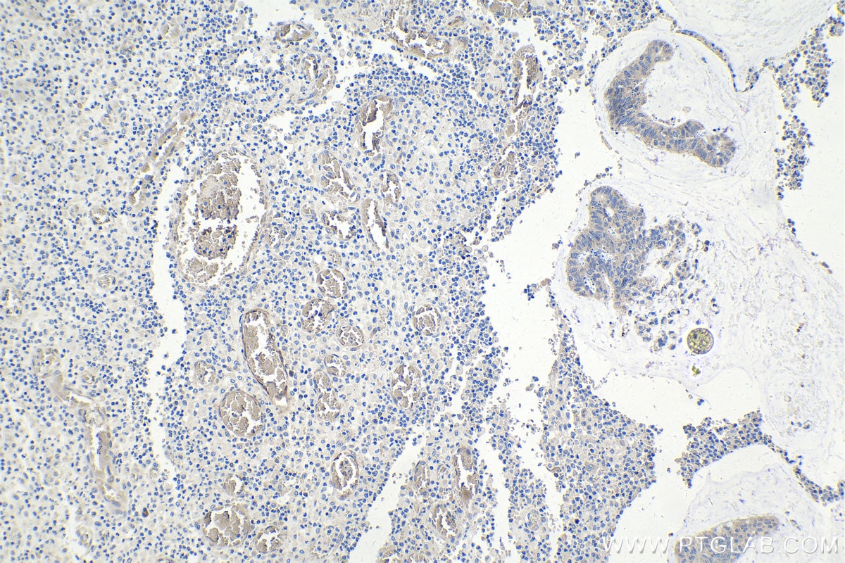 Immunohistochemistry (IHC) staining of human colon cancer tissue using LC3 Recombinant antibody (81004-1-RR)