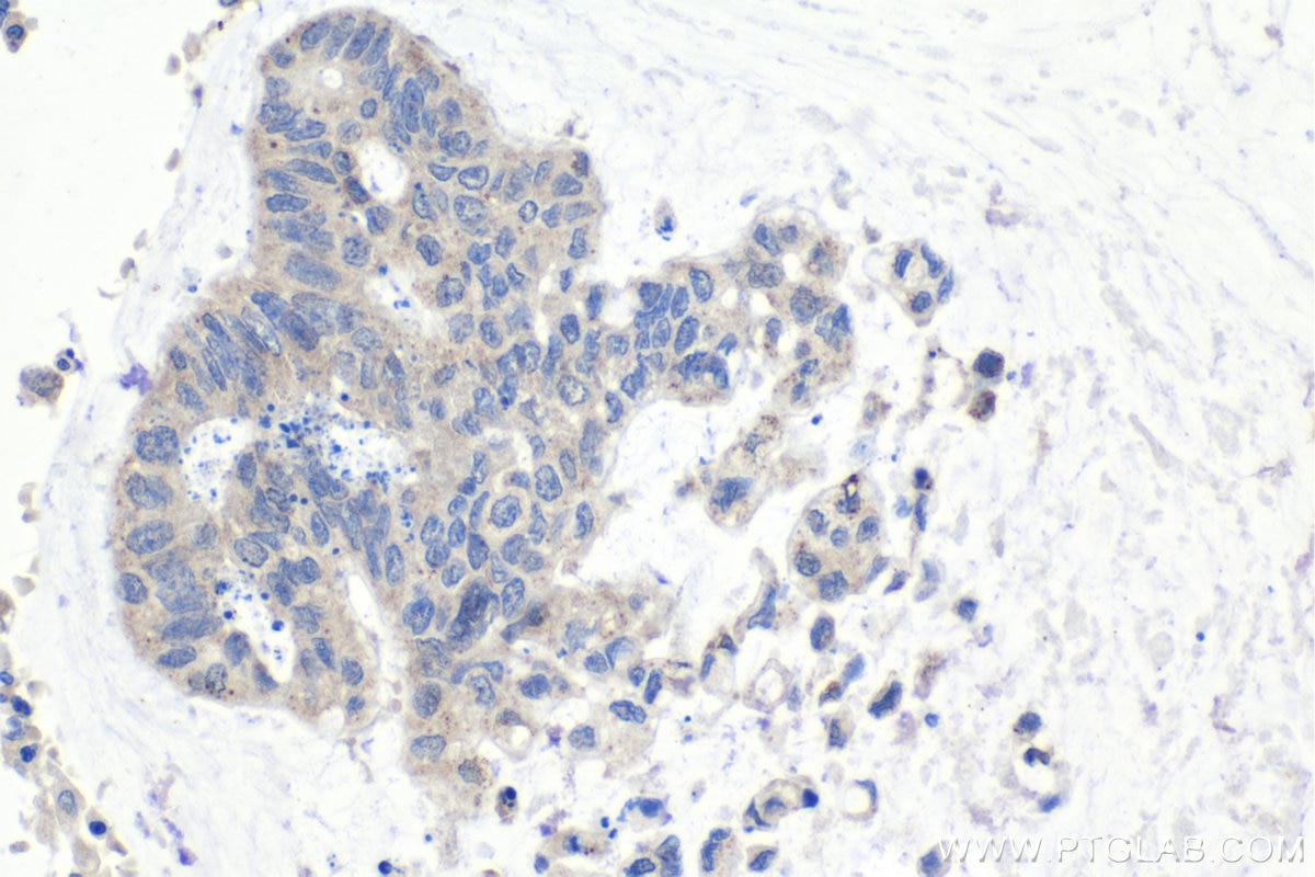 Immunohistochemistry (IHC) staining of human colon cancer tissue using LC3 Recombinant antibody (81004-1-RR)