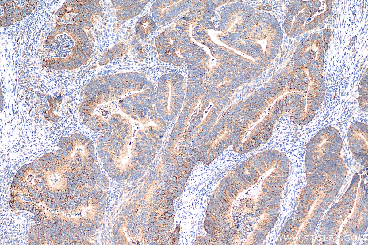 Immunohistochemistry (IHC) staining of human colon cancer tissue using LC3 Recombinant antibody (81004-1-RR)