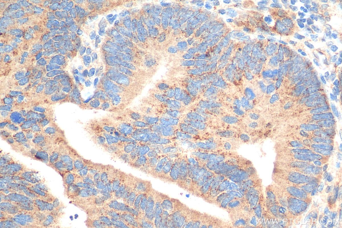 Immunohistochemistry (IHC) staining of human colon cancer tissue using LC3 Recombinant antibody (81004-1-RR)