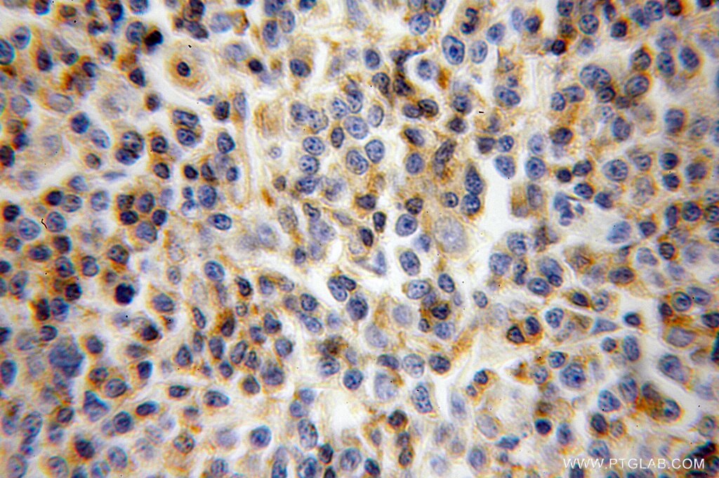 Immunohistochemistry (IHC) staining of human lymphoma tissue using LCK Polyclonal antibody (12477-1-AP)