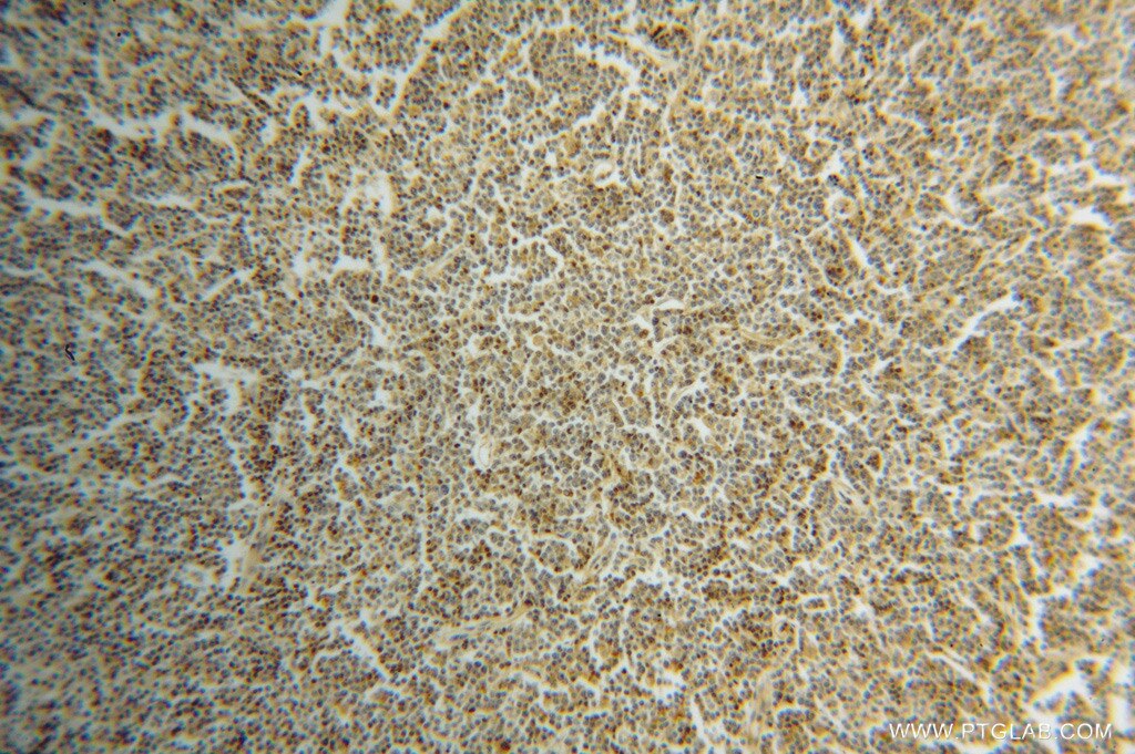 IHC staining of human lymphoma using 12477-1-AP