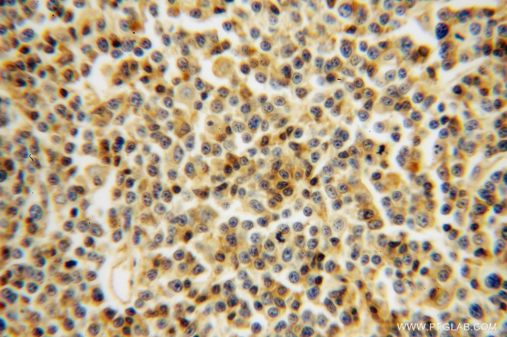 Immunohistochemistry (IHC) staining of human lymphoma tissue using LCK Polyclonal antibody (12477-1-AP)