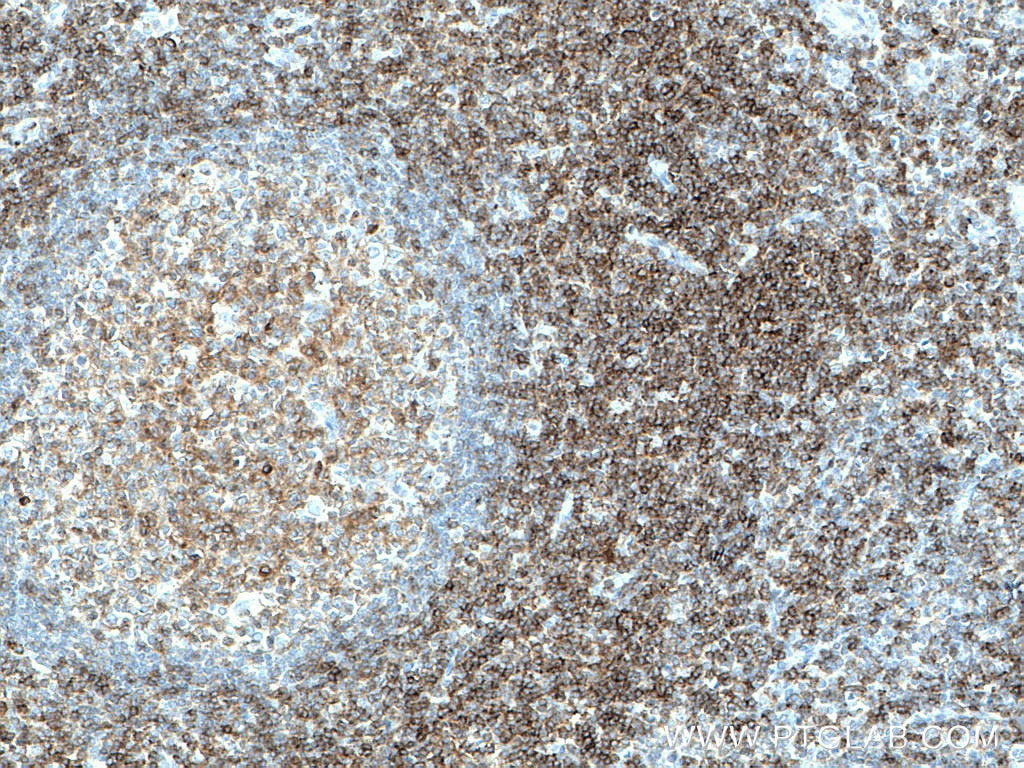 Immunohistochemistry (IHC) staining of human tonsillitis tissue using LCK Monoclonal antibody (60162-1-Ig)