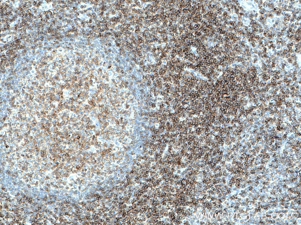 IHC staining of human tonsillitis using 60162-1-Ig