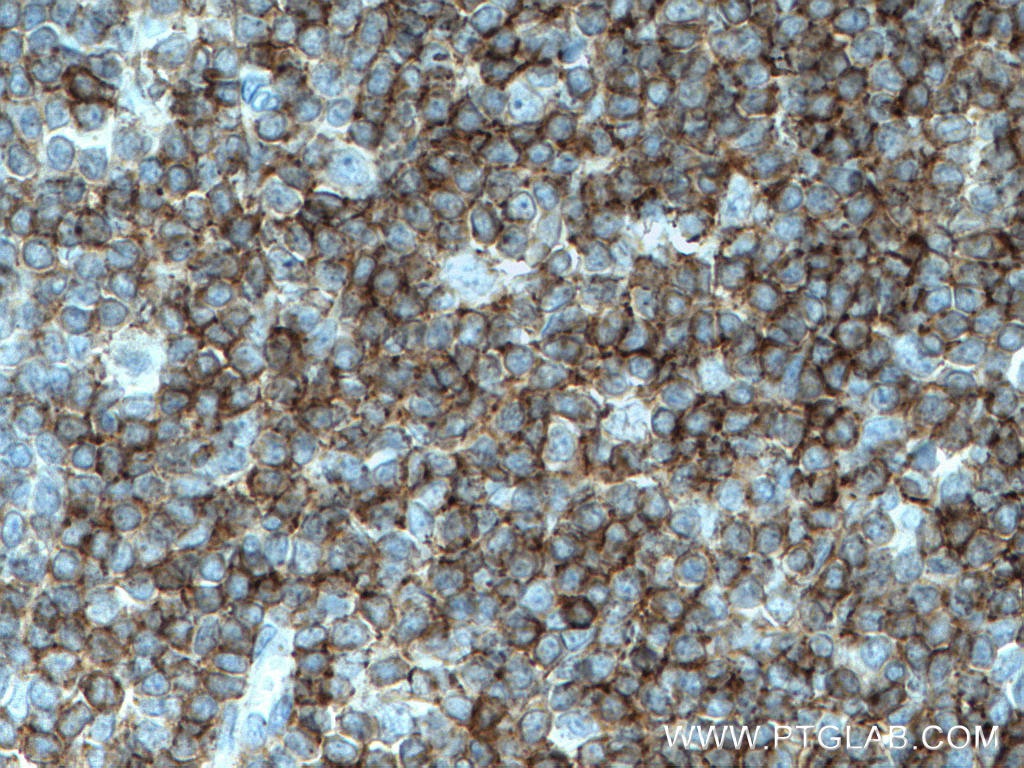 Immunohistochemistry (IHC) staining of human tonsillitis tissue using LCK Monoclonal antibody (60162-1-Ig)