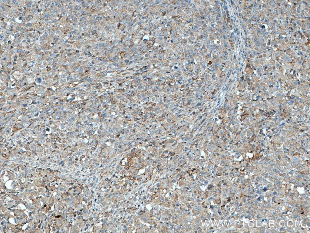 Immunohistochemistry (IHC) staining of human lymphoma tissue using LCK Monoclonal antibody (60162-1-Ig)