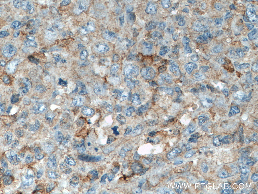 Immunohistochemistry (IHC) staining of human lymphoma tissue using LCK Monoclonal antibody (60162-1-Ig)