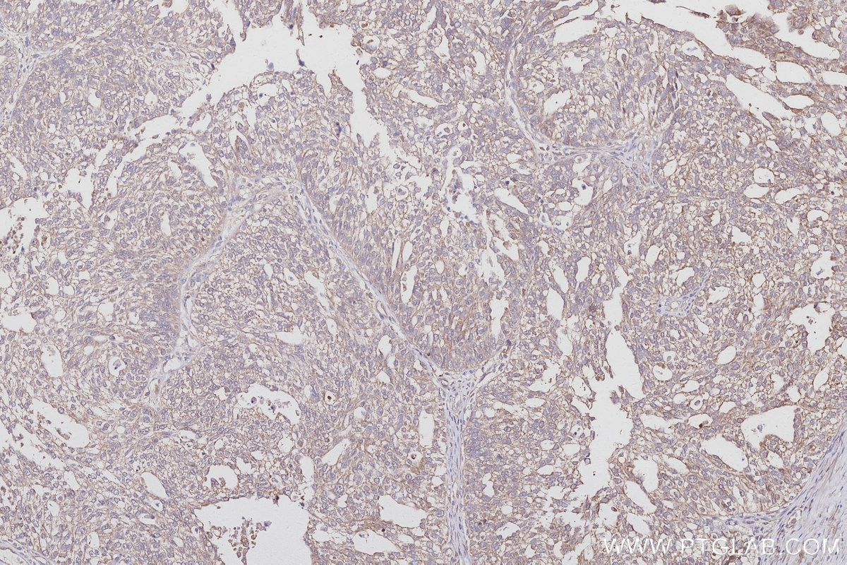 IHC staining of human ovary cancer using 30222-1-AP Immunohistochemistry (IHC) staining of human ovary cancer tissue using LCMT1 Polyclonal antibody (30222-1-AP)
