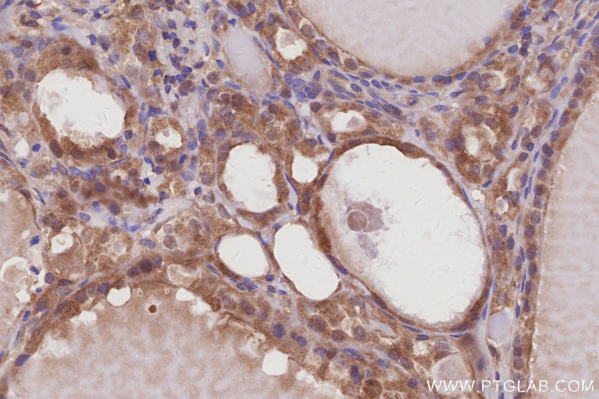 IHC staining of human thyroid cancer using 30222-1-AP Immunohistochemistry (IHC) staining of human thyroid cancer tissue using LCMT1 Polyclonal antibody (30222-1-AP)
