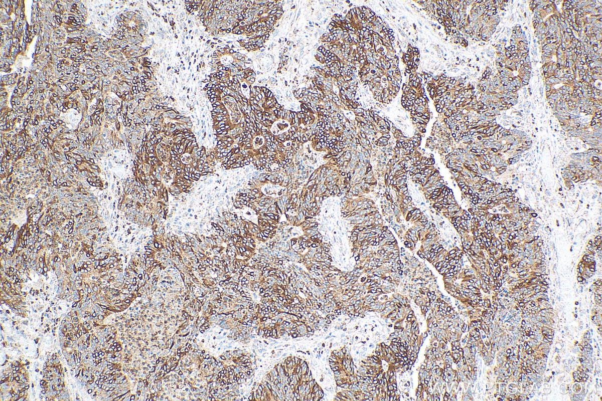 Immunohistochemistry (IHC) staining of human colon cancer tissue using LCN2 Polyclonal antibody (26991-1-AP)