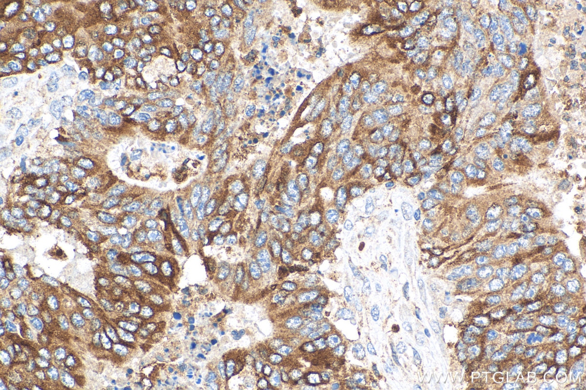 Immunohistochemistry (IHC) staining of human colon cancer tissue using Lipocalin-2/NGAL Polyclonal antibody (26991-1-AP)