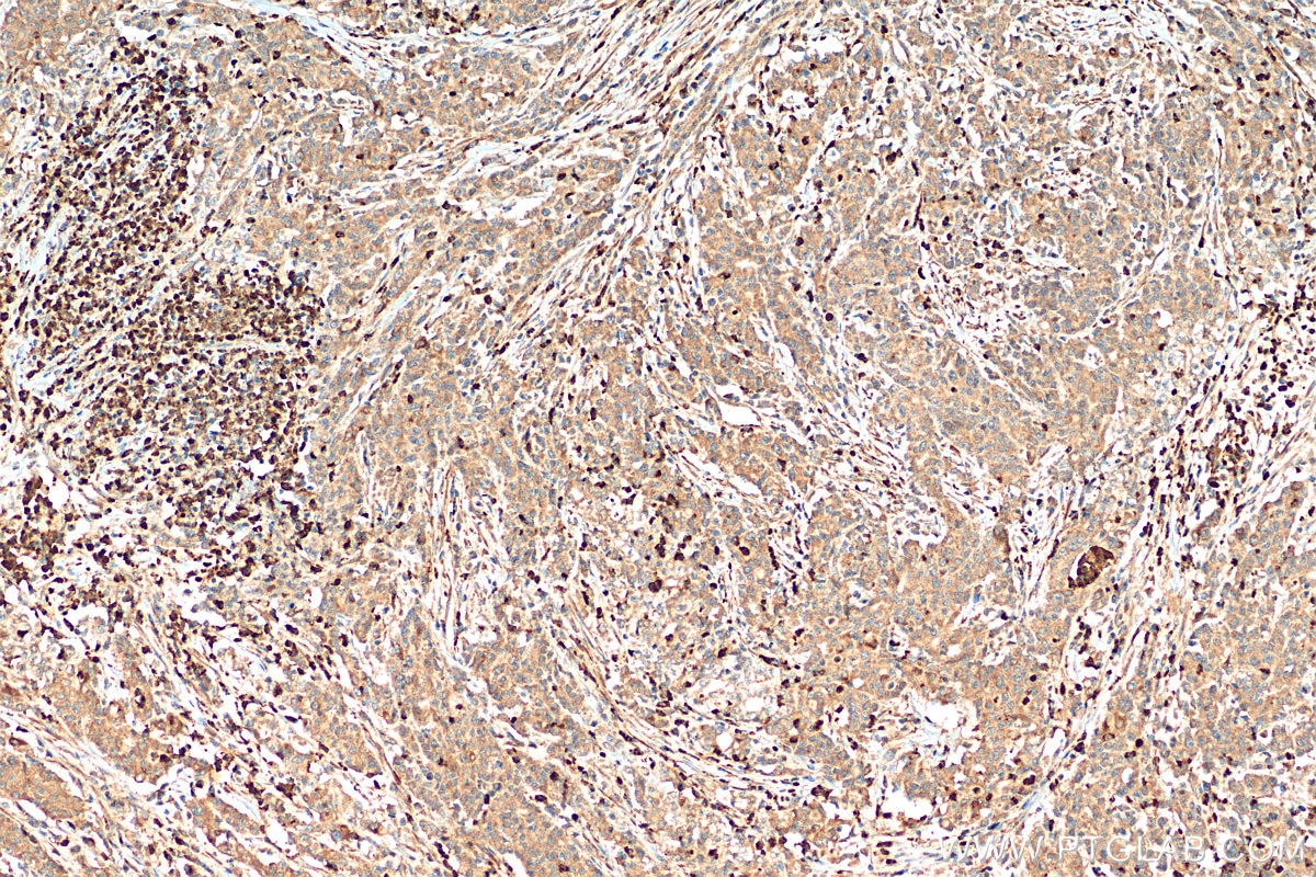 Immunohistochemistry (IHC) staining of human stomach cancer tissue using Lipocalin-2/NGAL Polyclonal antibody (26991-1-AP)