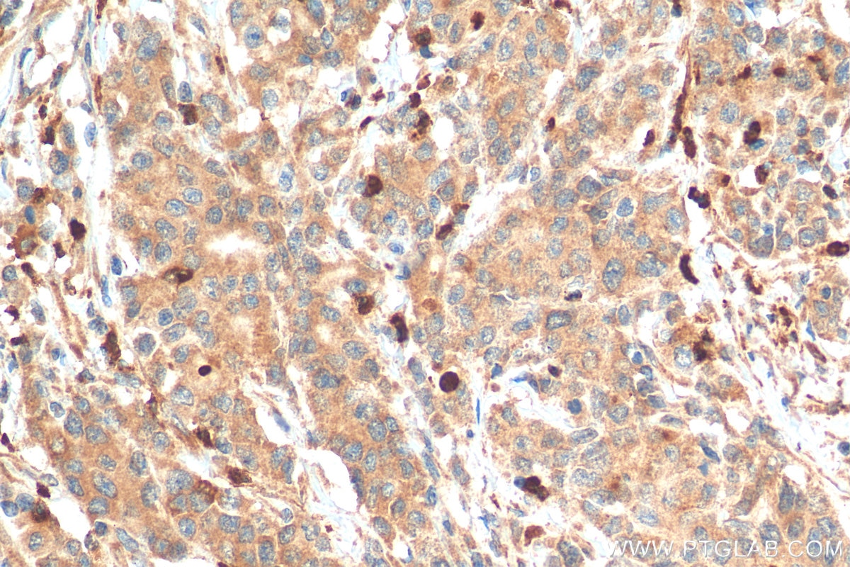 Immunohistochemistry (IHC) staining of human stomach cancer tissue using LCN2 Polyclonal antibody (26991-1-AP)